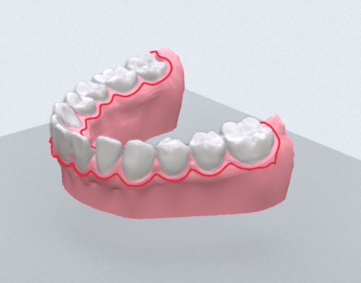 Upper and lower arches in occlusion, with the gum margin traced tooth by tooth on both arches.