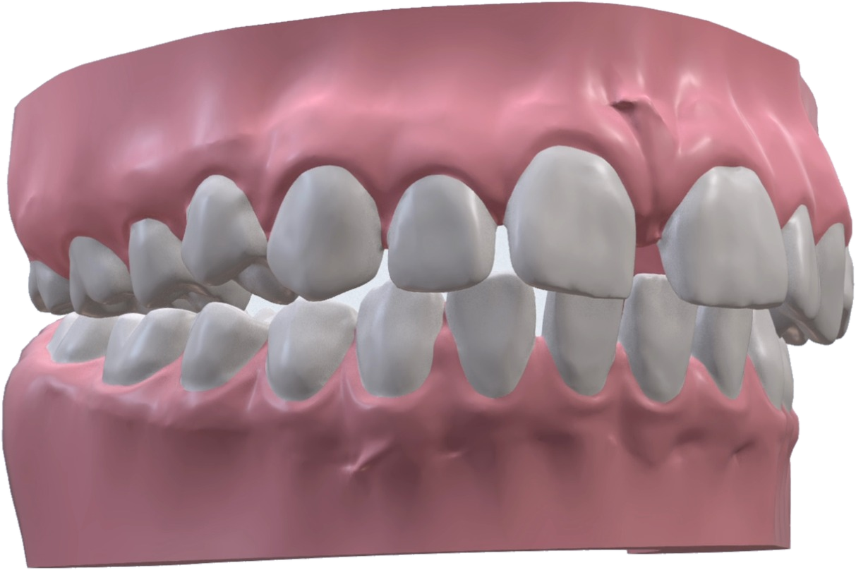 An AI-segmented 3D model from a patient scan, each tooth separated from the gingiva.